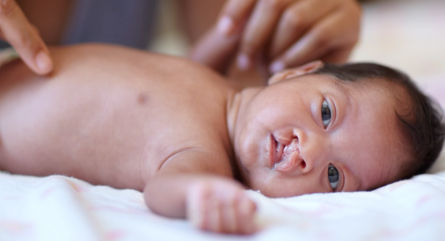 baby with a cleft lip / hairlip