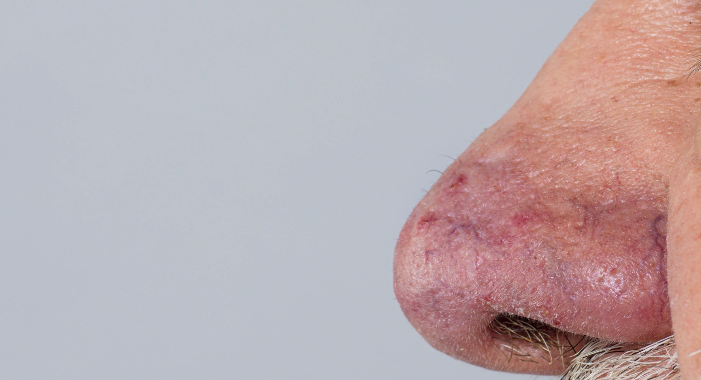 rhinophyma