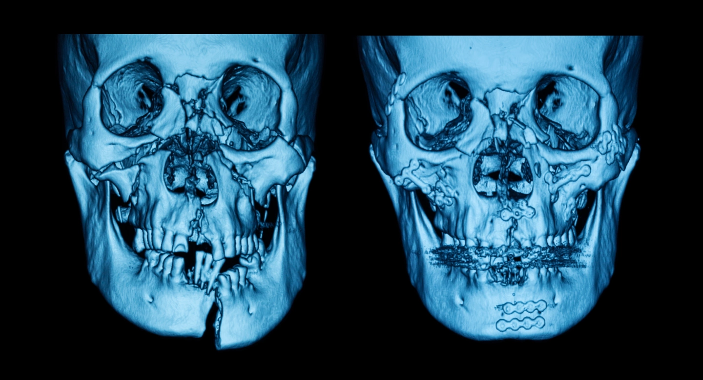 Primary reconstruction, stabilizing facial fractures